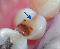 Horizontal Tooth Fracture