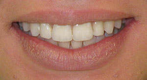 Demineralized Teeth