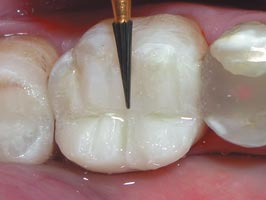 Tooth Occlusal Anatomy