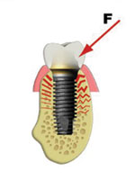 short dental implants literature review