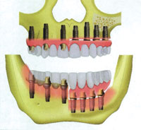 short dental implants literature review