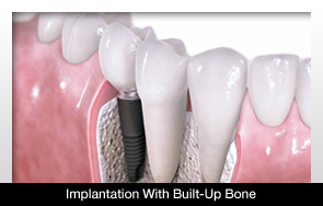 Two-Step Implantation with Built-up Bone May be More Effective