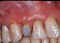 Gingivectomy And Gingivoplasty