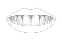 A Conservative Approach to Restoring a Canted Smile