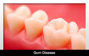 Gum Disease May Cause Head, Neck Cancer