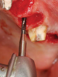 Clinical Pearls for Surgical Implant Dentistry