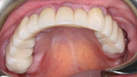 Extracting Teeth With Less Trauma