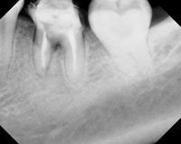 Apical Surgery on Fractured Roots: Case Reports