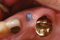 Improving Implant Impressions