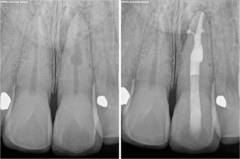 The Endodontic Glidepath: “Secret to Rotary Safety”