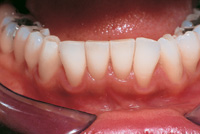 Mandibular Anterior Teeth