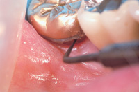 Buccal Lesion