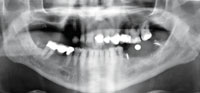 Simplifying Fixed Implant Dental Prosthetics Dentistry Today