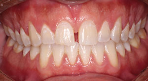 The Architect Of The Smile A Midline Diastema Closure Dentistry Today