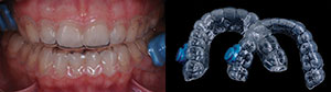 Enamel Microabrasion Associated With Monitored Bleaching Dentistry Today