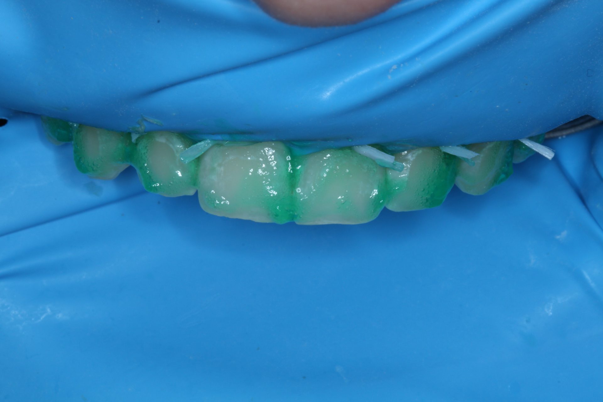 White Spot Lesions Treatment With Resin Infiltration Dentistry Today