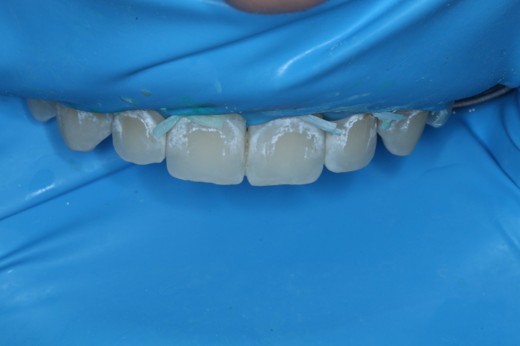 White Spot Lesions Treatment With Resin Infiltration Dentistry Today