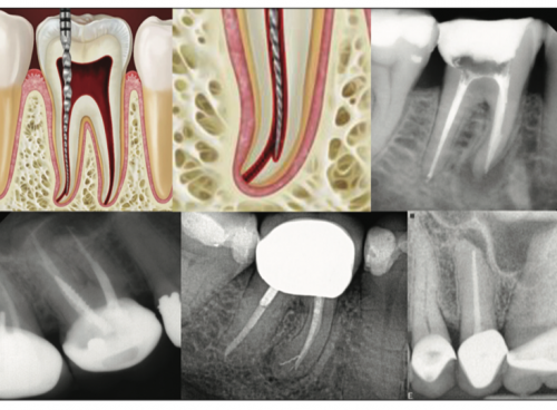 Articles Magazine Endodontics Endodontics Dentistry Today