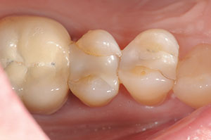 gic dental filling