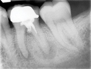 Clinical Tips For Instrumenting Calcified Canals Dentistry Today