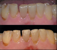 Anterior Restorations Performance Of Ceramic Veneers Full Text At Quintessence Partner