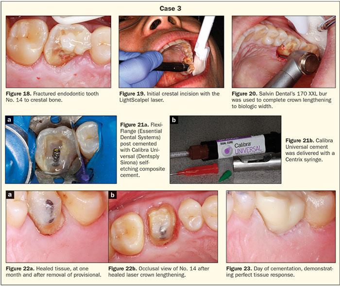 Practical Laser Applications In General Practice Dentistry Today