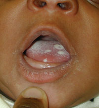 oral candidiasis in infants