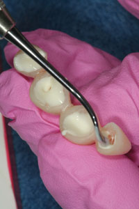 fuji tooth filling