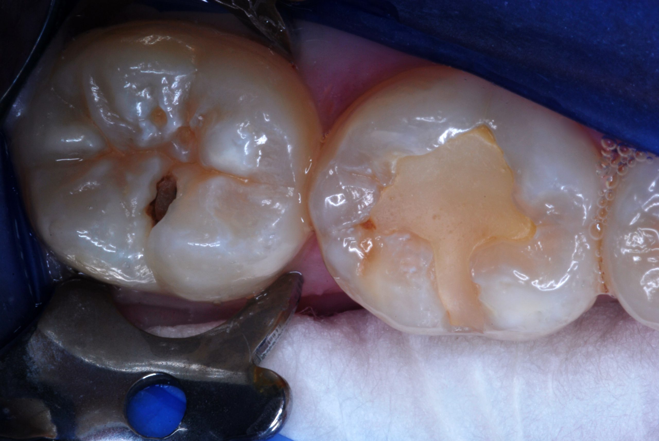 Glass ionomer clearance filling