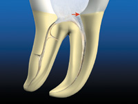 Finishing the Apical One Third: Endodontic Considerations - Dentistry Today