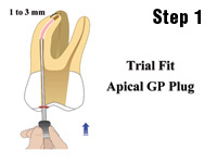 Simple, Precise, and Predictable Root Canal Obturation - Dentistry Today