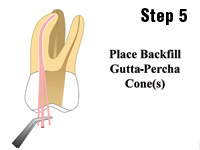 Simple, Precise, and Predictable Root Canal Obturation - Dentistry Today