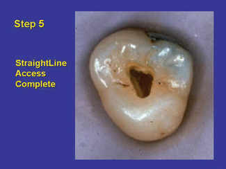 Straight-line? Access: A Must for Faster and Better Endodontics ...