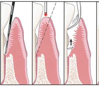 Eight-Year Retrospective Review of Laser Periodontal Therapy in Private ...