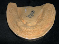 The Suction Cup Denture A Century Old Technology Reborn Dentistry Today