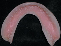 The Suction Cup Denture A Century Old Technology Reborn Dentistry Today