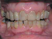 Aesthetic Correction Of A Damaged Occlusion Using Varied Preparation ...