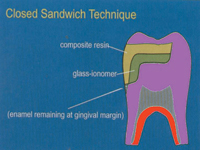 The Role of Glass Ionomers in Minimally Invasive Restorative