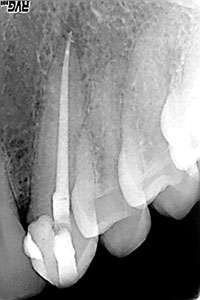 Progressive Taper Technology: Rationale and Clinical Technique for the ...