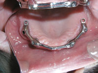 Treatment Planning Attachments and Implants - Dentistry Today