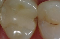 Introducing the Clark Class II Restoration – Dentistry Today