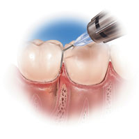 The Standard of Care for Nonsurgical Periodontal Treatment for Reducing ...