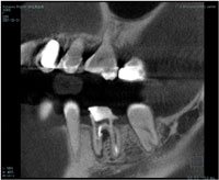 Apical Surgery on Fractured Roots: Case Reports - Dentistry Today