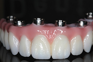 ZIRCONIA IMPLANT BRIDGE - Tischler Dental Laboratory - Dentistry Today