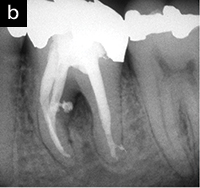 Differential Diagnosis of Toothache Pain: Part 1, Odontogenic ...