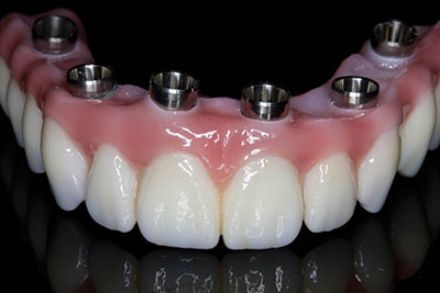 Tischler Dental - Implant Bridge - Dentistry Today