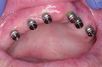 The Easy Way Versus the Hard Way: Planning the Open Palate Maxillary ...