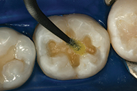 Optimize Finishing and Polishing of Posterior Composites - Dentistry Today