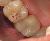 Making Difficult Cases Easier With Supragingival Dentistry: Porcelain ...