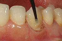 “Smart” Class V Preparation Design for Direct Composites - Dentistry Today